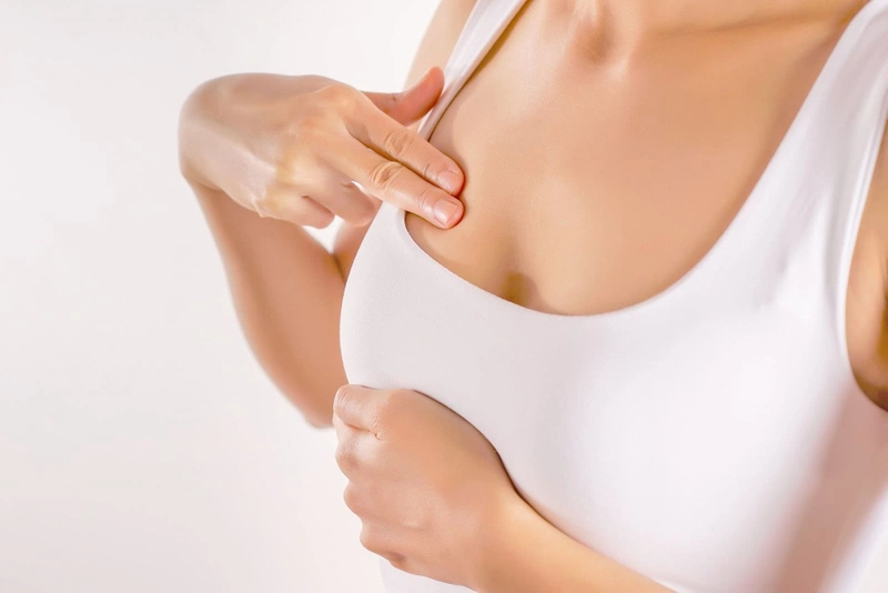 Vú bên to bên nhỏ do tăng sản ống dẫn không điển hình