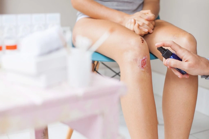 Người bệnh chốc lở nặng nên làm gì để nhanh khỏi bệnh