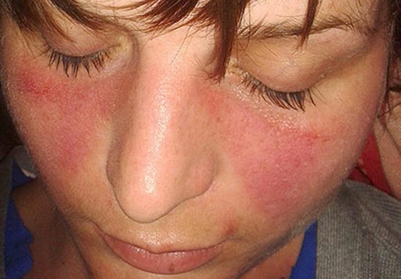 Người bệnh lupus ban đỏ ăn thịt bò được không? 1