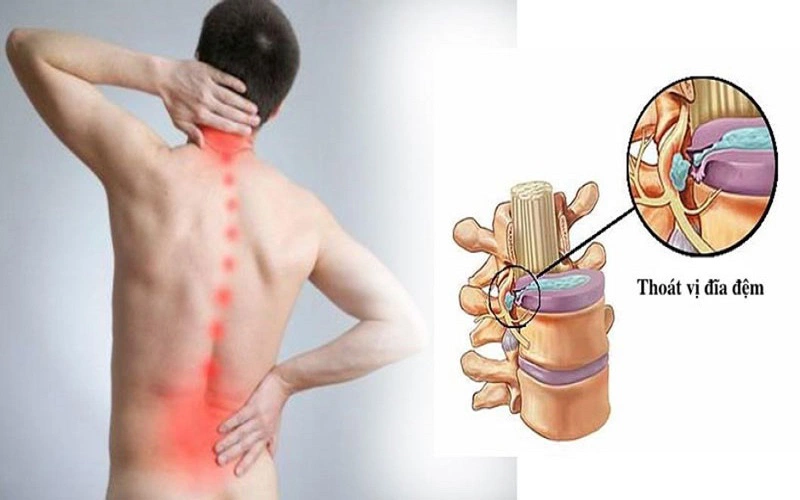 Bị bệnh thoát vị đĩa đệm có nên đi bộ không?