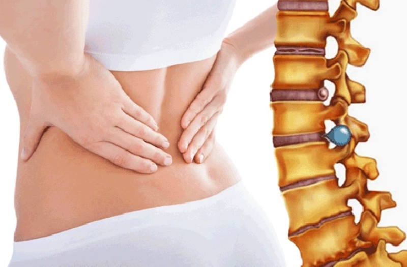 Thoát vị đĩa đệm có nên đi bộ không