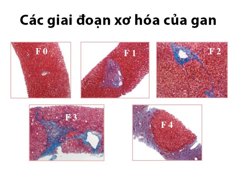 Người bị bệnh xơ gan F4 sống được bao lâu?1