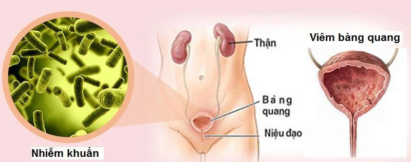 Người bị viêm bàng quang nên ăn những loại thực phẩm gì 1