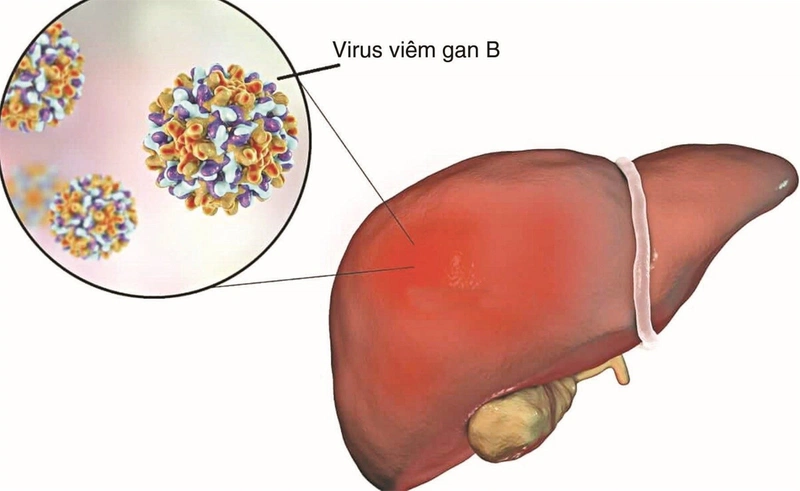 Người bị xơ gan giai đoạn cuối sống được bao lâu?1