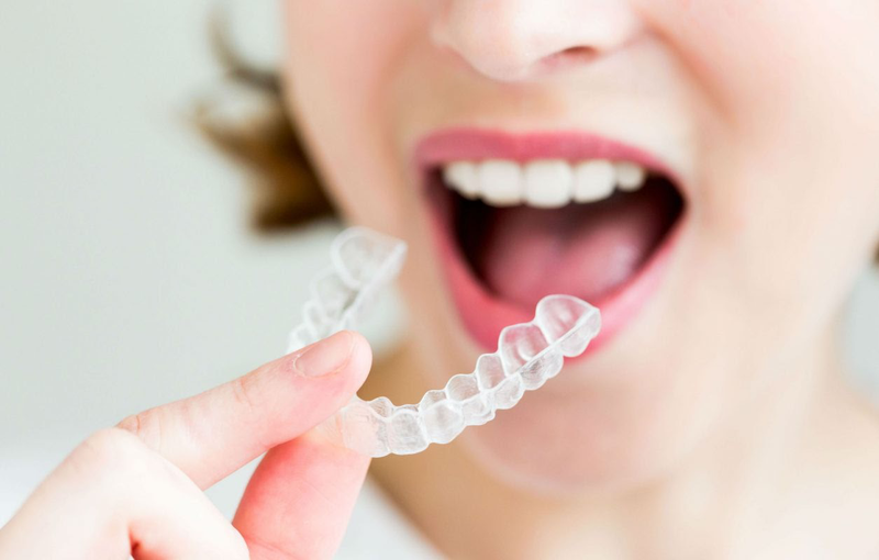 Người lớn tuổi niềng răng được không 3