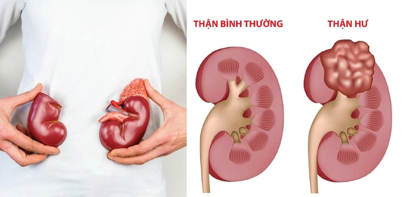 Người mắc hội chứng thận hư điều trị bao lâu thì khỏi hẳn?2