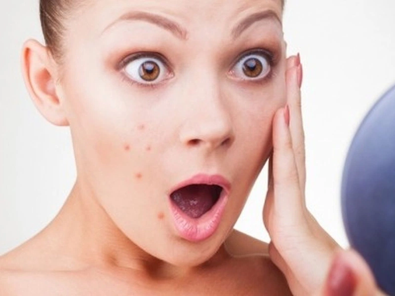 Nguy hiểm khôn lường từ thói quen nặn mụn 5