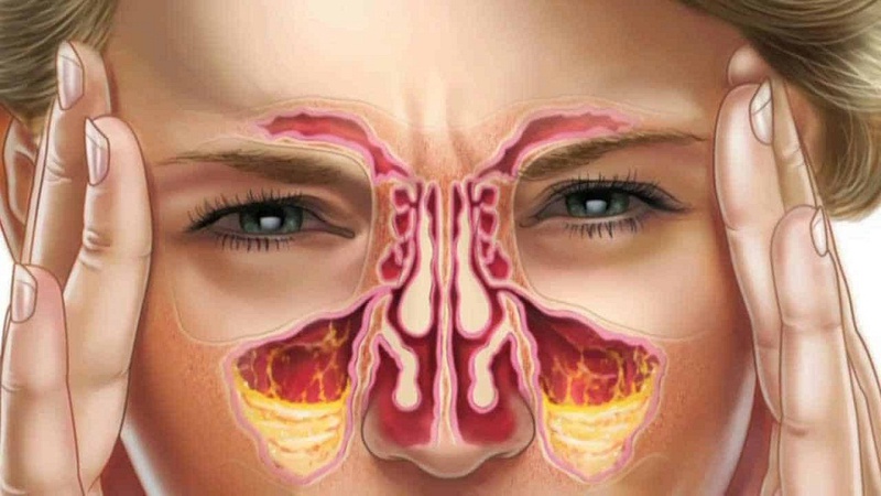Nguyên nhân bệnh viêm xoang phổ biến nhất là gì 1