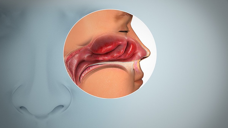 Nguyên nhân bệnh viêm xoang phổ biến nhất là gì 2