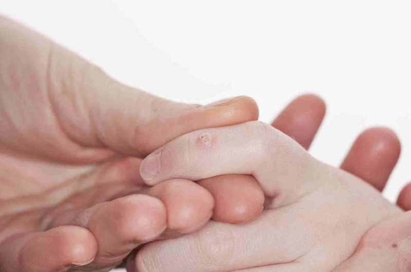 Nguyên nhân bị mụn cóc là do đâu 1