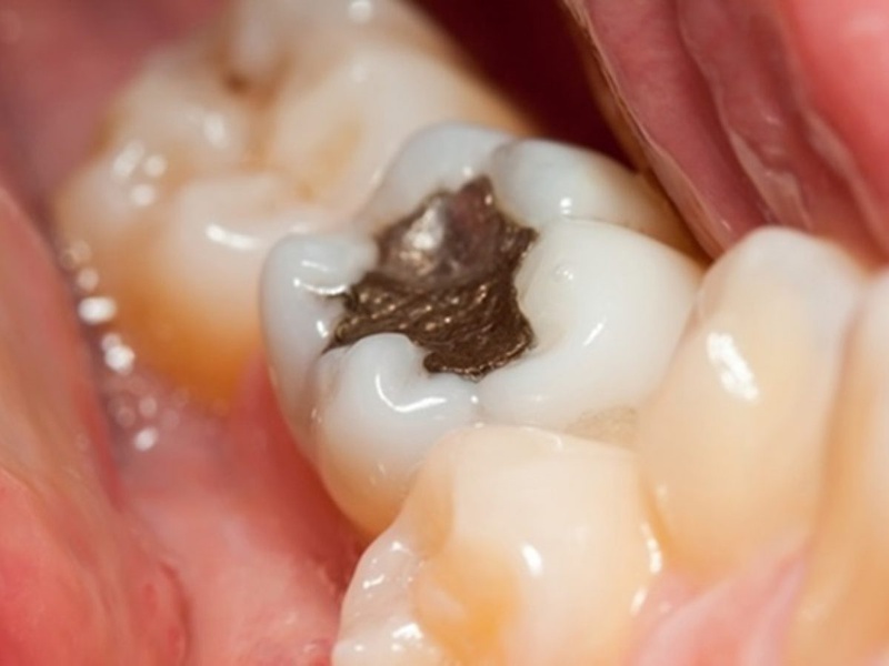 Tình trạng răng bị sâu lỗ to được chia thành 3 mức độ khác nhau