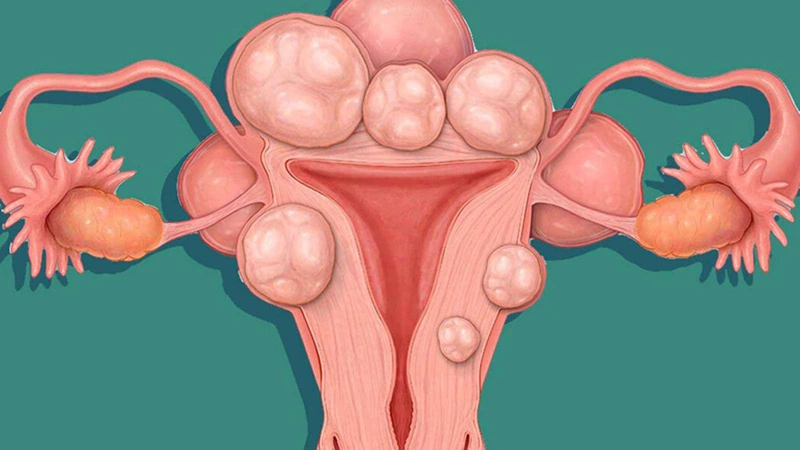 Nguyên nhân, cách phòng ngừa đau thắt lưng và trễ kinh 2