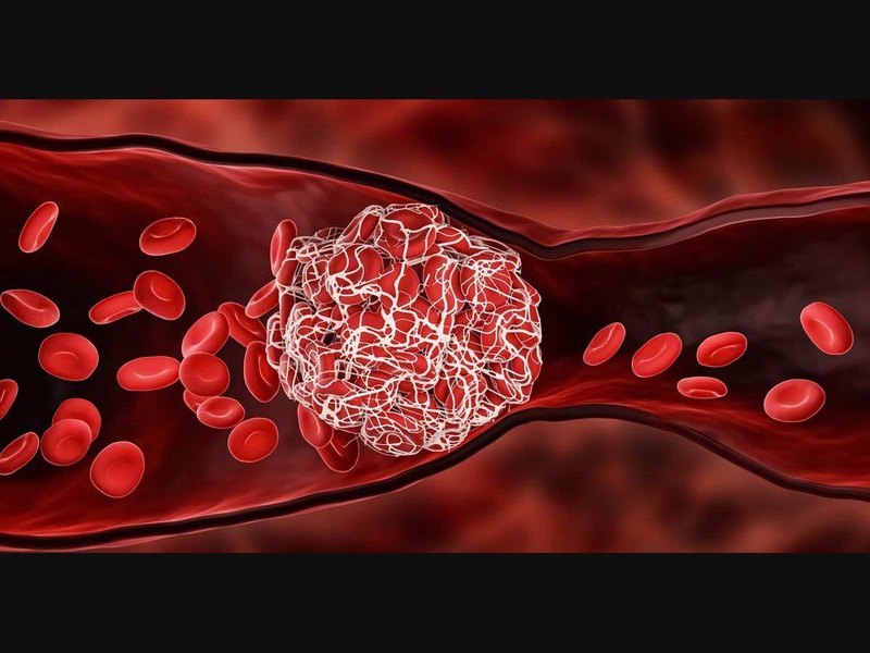 Hiện thượng thuyên tắc xảy ra là khi một huyết khối trôi theo dòng máu cho tới khi bị mắc kẹt ở một mạch máu hẹp hơn