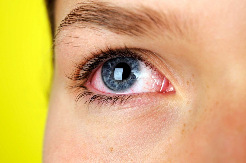 Nguyên nhân đau mắt đỏ và những triệu chứng thường gặp 3