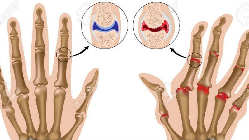 Nguyên nhân gây đau khớp ngón tay và cách điều trị 2