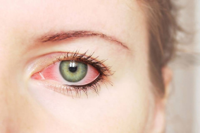 Nguyên nhân gây đau mắt đỏ giảm thị lực