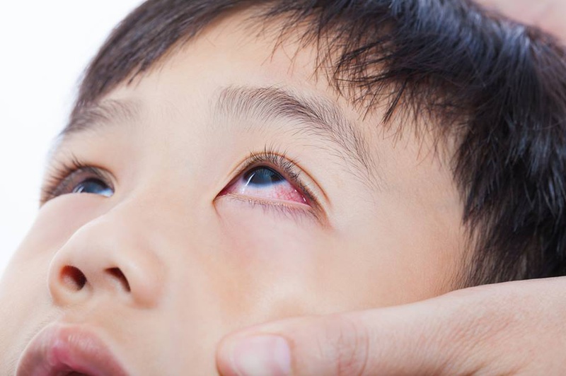 Nguyên nhân gây đau mắt đỏ giảm thị lực 1