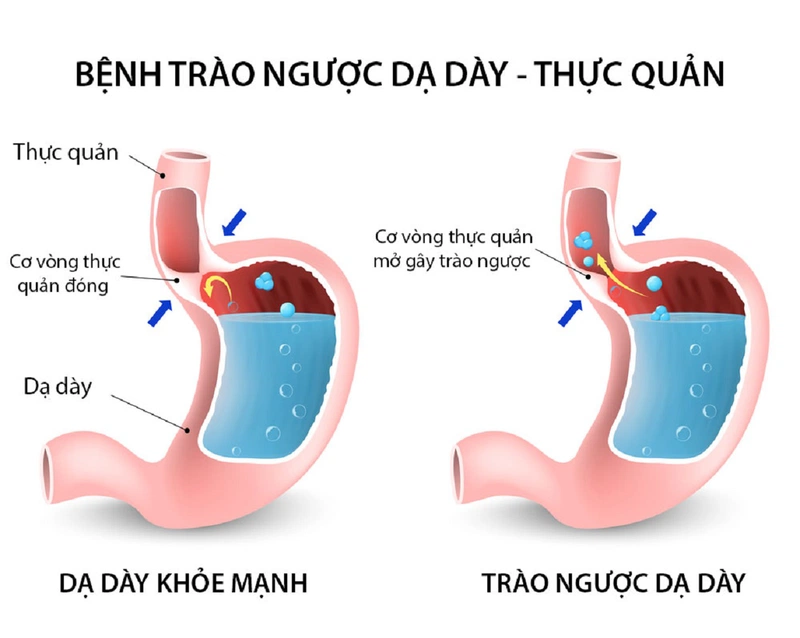 Nguyên nhân gây hiện tượng trào ngược dạ dày axit 1