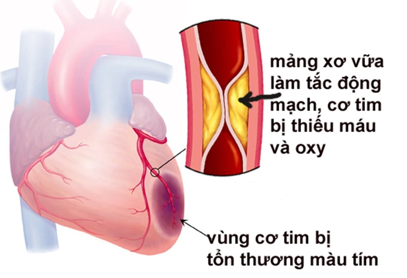 Nguyên nhân gây nhói tim là gì? Bị nhói tim có nguy hiểm không? 3