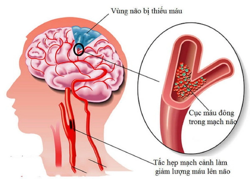 Bệnh thiếu máu não là gì? Phương pháp điều trị thiếu máu não bằng Đông y 1