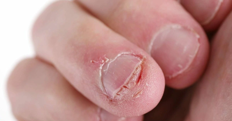 Móng tay có đốm trắng do móng bị tổn thương