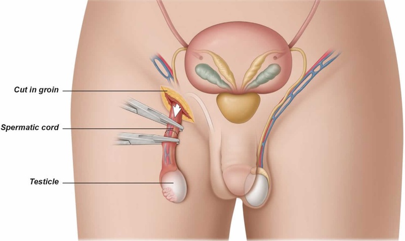 Nguyên nhân gây ra tình trạng tinh hoàn ẩn là gì?1