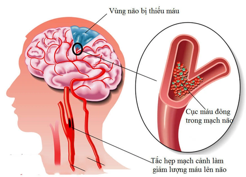 Bệnh đột quỵ có thể là nguyên nhân gây hồng cầu hình lưỡi liềm