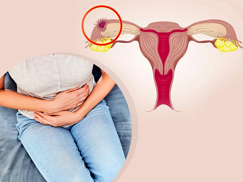 Nguyên nhân gây trễ kinh và ra dịch màu hồng 4