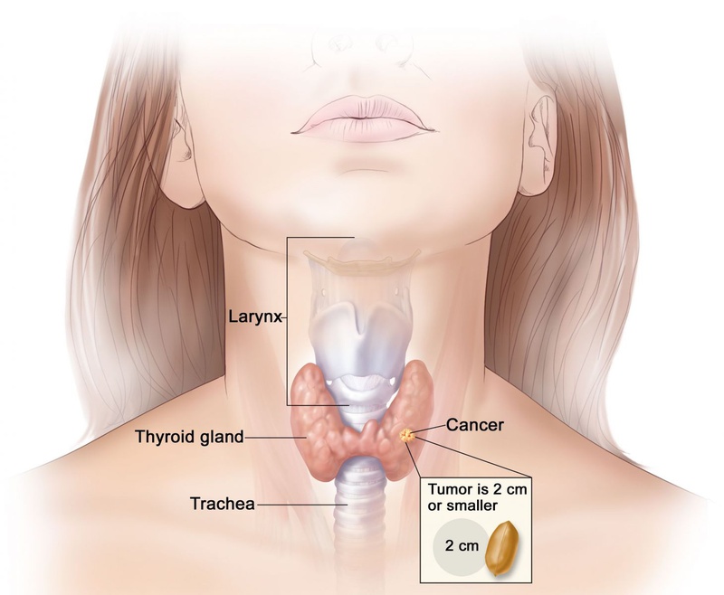 Nguyên nhân gây ung thư tuyến giáp2