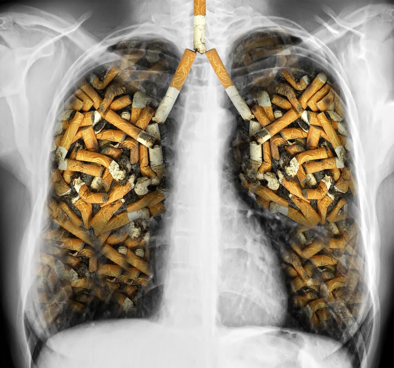 Nguyên nhân nào gây ra bệnh ung thư phổi?2