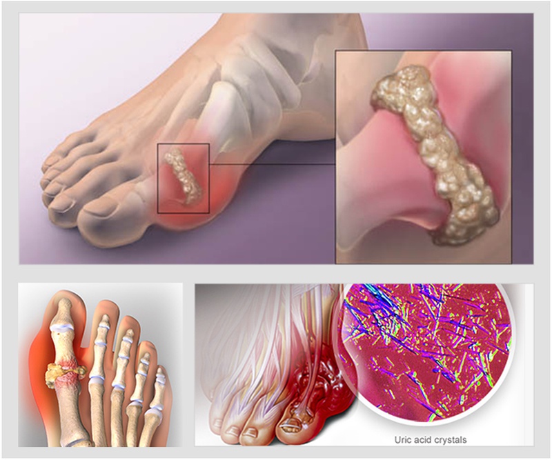 Nguyên nhân nào khiến bệnh gout càng trở nên trầm trọng 1