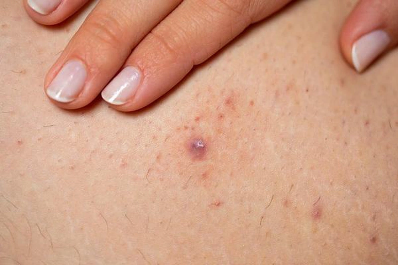 Nguyên nhân nổi hạch sau gáy - Sưng hạch sau gáy có nguy hiểm không? 3