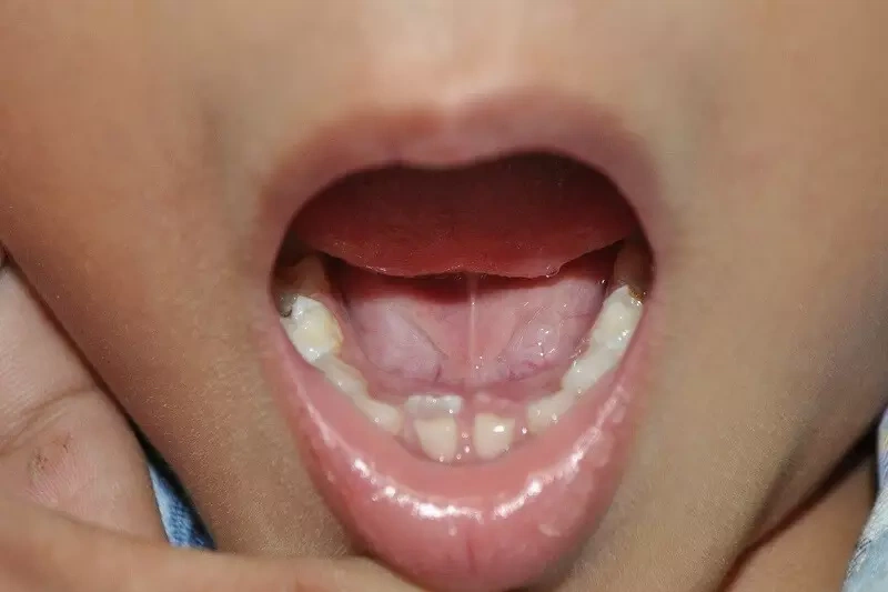 Nguyên nhân răng mọc lẫy thường gặp là gì? Cách xử lý răng mọc lẫy mà cha mẹ cần biết 1