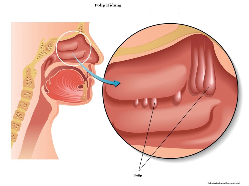 Nguyên nhân sổ mũi nghẹt mũi và hướng điều trị 2