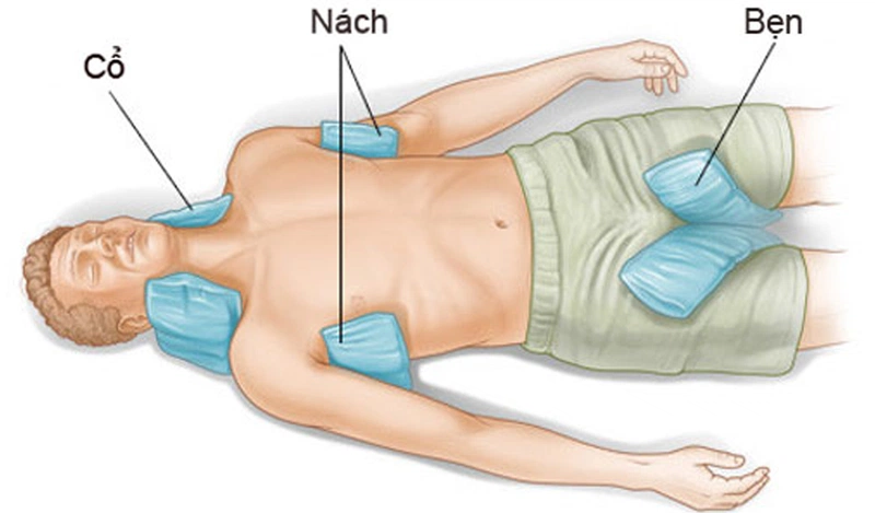 Chườm đá cổ, nách, bẹn cho bệnh nhân sốc nhiệt