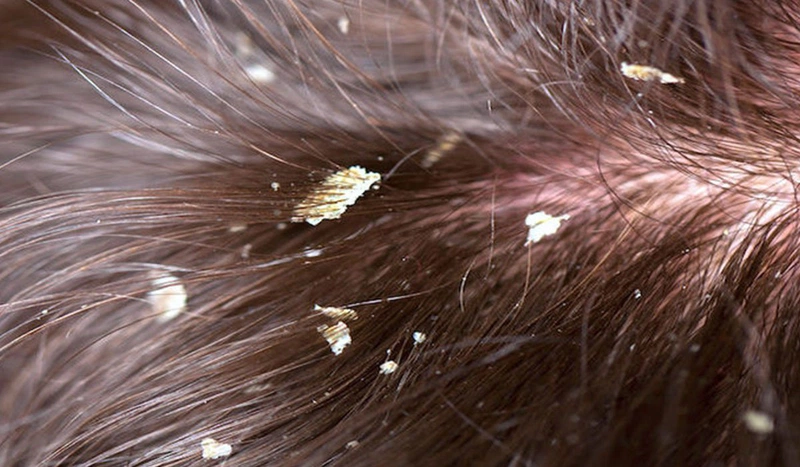 Nguyên nhân tóc bị gàu mảng và cách phòng ngừa hiệu quả