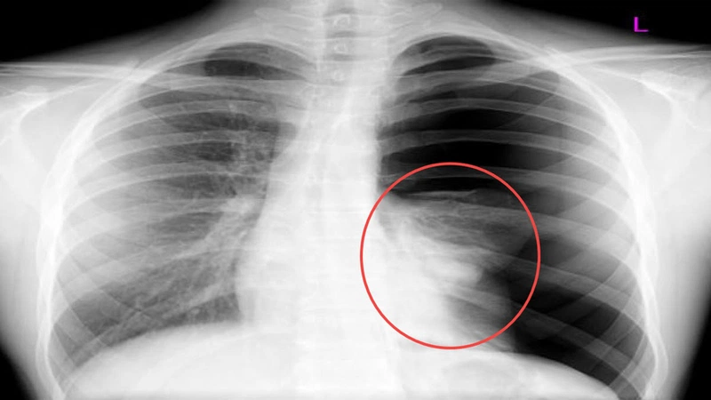 Nguyên nhân tràn dịch màng phổi thường gặp nhất