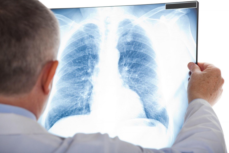 Bệnh lao cũng có thể là nguyên nhân gây tràn dịch màng phổi