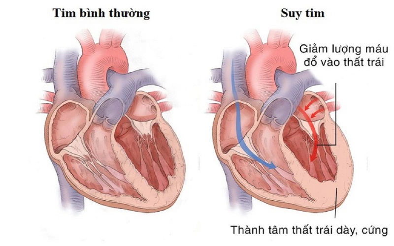 Suy tim là bệnh lý suy yếu của tim