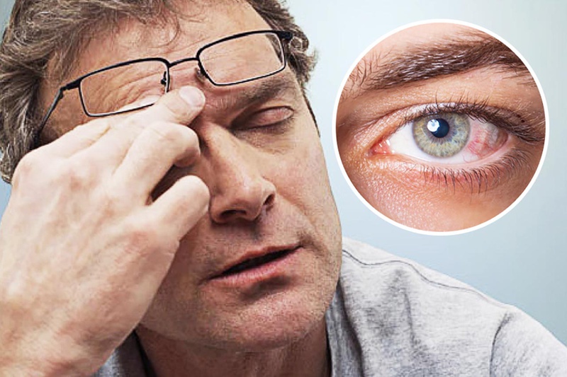 Bệnh khô mắt do thiếu vitamin A là gì? Cách điều trị khô mắt do thiếu vitamin A?