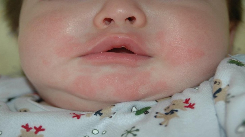 Nguyên nhân gây nổi mề đay quanh miệng ở trẻ.