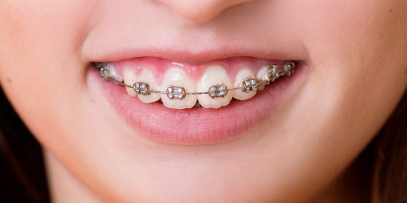 Các dấu hiệu tụt lợi khi niềng răng có thể gây ảnh hưởng đến sức khỏe răng miệng