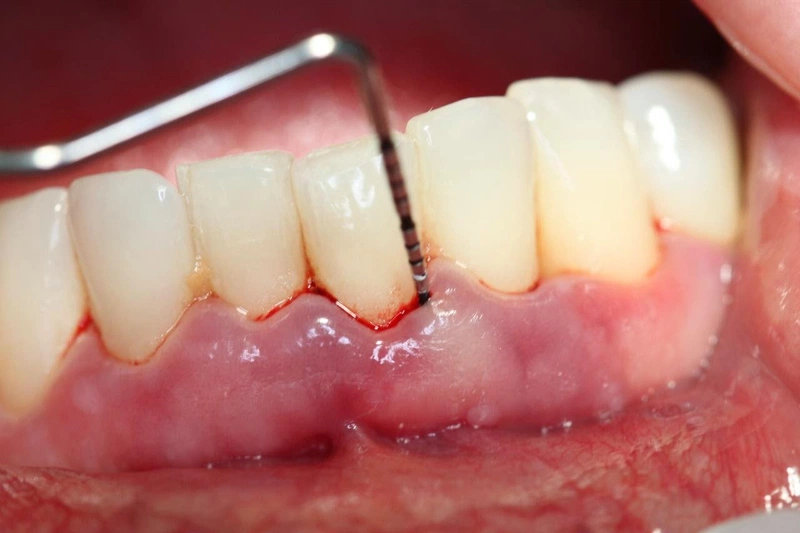 Một số nguyên nhân phổ biến khiến răng bị tụt lợi khi niềng