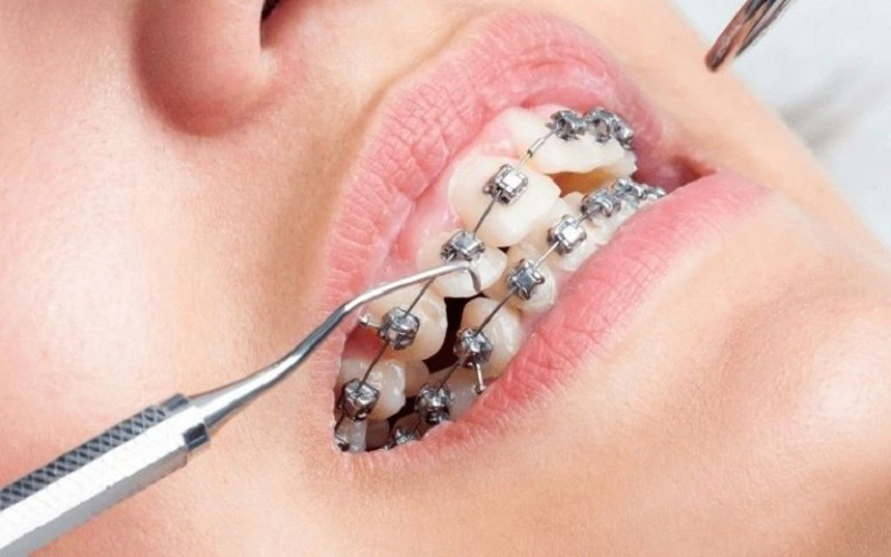 Một số giải pháp phòng ngừa tụt lợi trong quá trình niềng răng