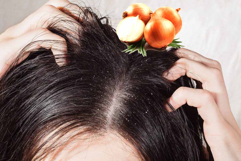 Nguyên nhân và cách khắc phục tình trạng làm tóc xong bị gàu