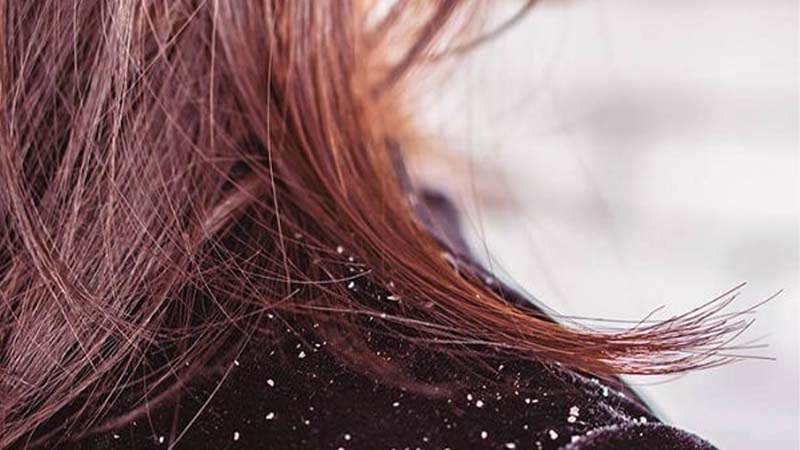 Cách chăm sóc tóc cho người bị nấm da đầu vào mùa đông  Báo Phụ Nữ Việt Nam