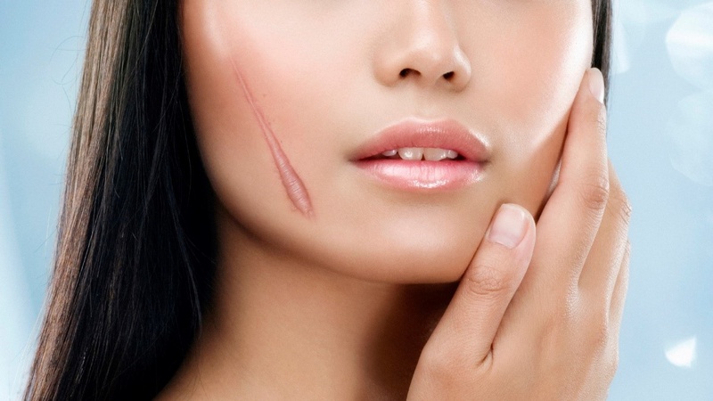 Nguyên nhân và phương pháp điều trị sẹo lồi ở quai hàm 1