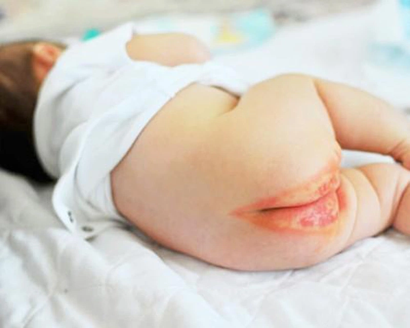 Nguyên nhân và triệu chứng dị ứng bỉm ở trẻ 2