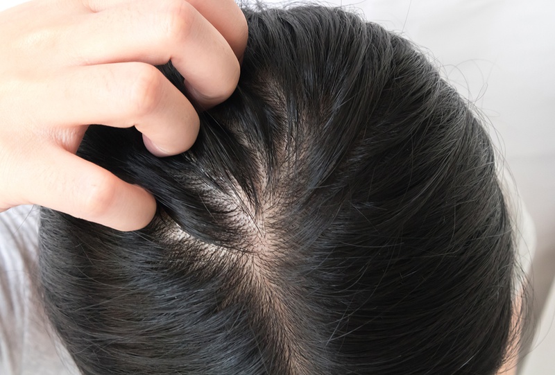Nguyên nhân viêm nang lông gây rụng tóc3