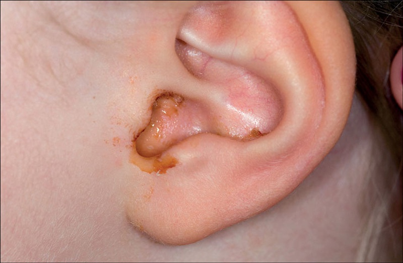 Những điều cần biết về bệnh lý tai chảy mủ 1